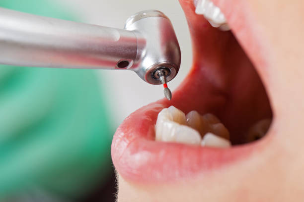 Best Emergency Dental Filling Replacement  in Fort Branch, IN